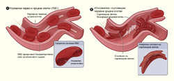 Нормални и сърповидни червени кръвни клетки