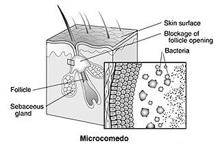 acnelesionsmicro