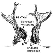 Хемороиди