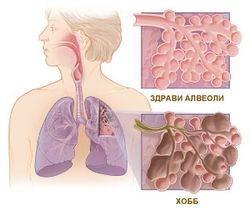 Здрави и увредени алвеоли