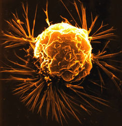 Туморна клетка при рак на гърдата