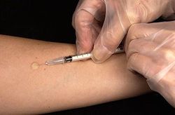 350pxmantoux_tuberculin_skin_test