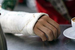 broken_arm1